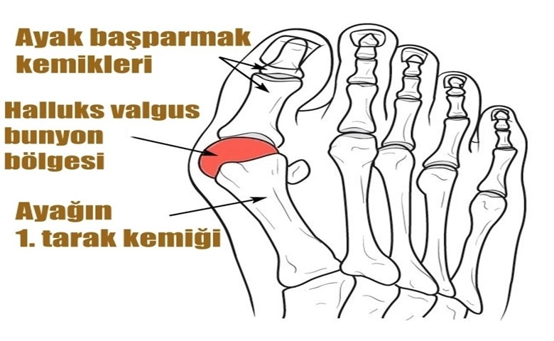 Dar ve sivri burunlu ayakkabılar