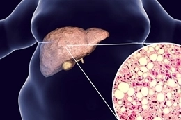 Sağlığa dikkat ; Karaciğer yağlanmasına işaret eden bu belirtileri hafife almayın