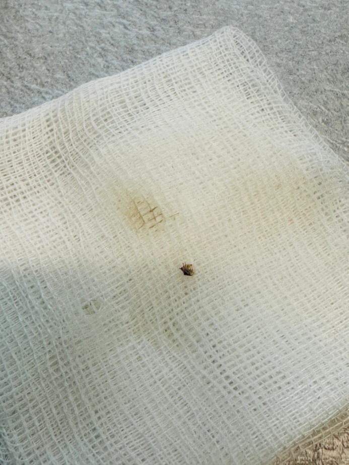 Halsizlik nedeniyle hastaneye gitti, karnına yapışan kene bulundu