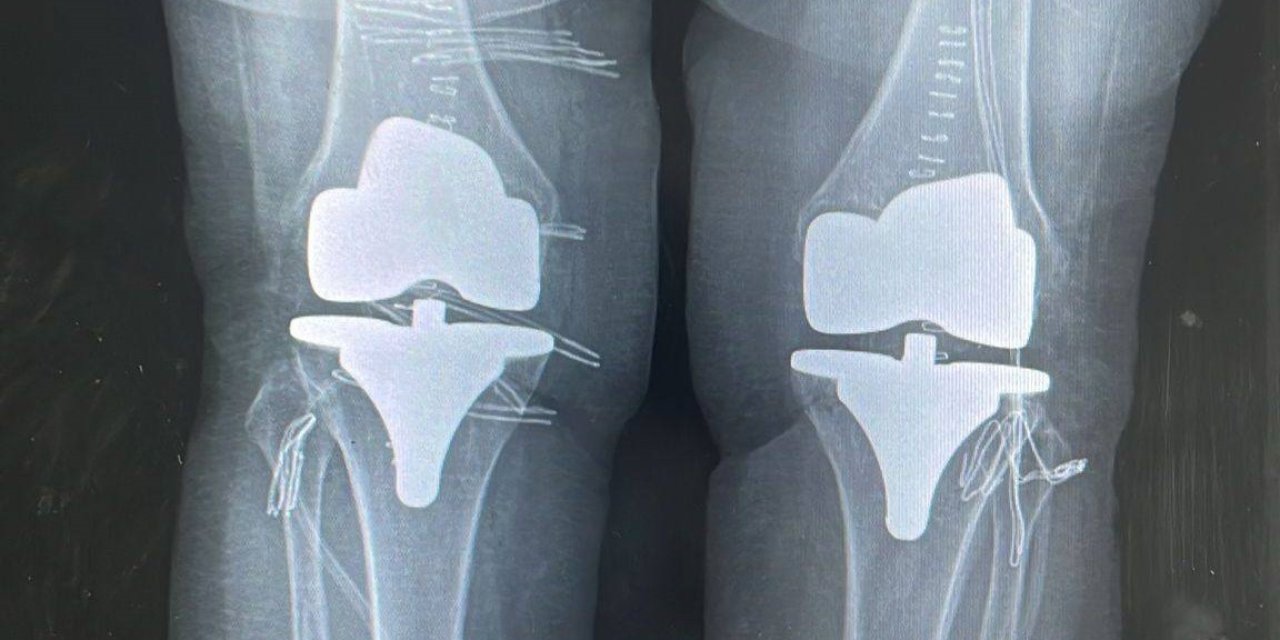 Çift taraflı diz proteziyle 73 yaşındaki hasta sağlığına kavuştu