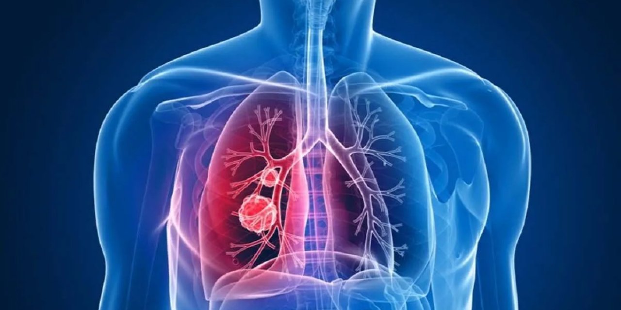 Zatürre yüksek ölüm oranı olan hastalık