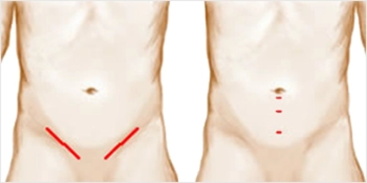 Kasık fıtığının tek çözümü ameliyat