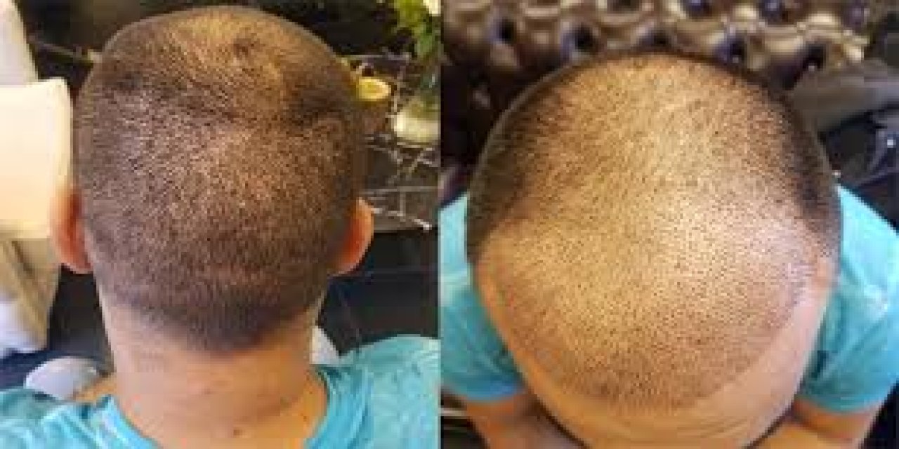 SANKO Hastanesine saç ekim merkezi açıldı