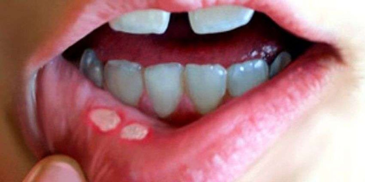 Uzmandan kritik uyarı: Behçet hastalığına dikkat