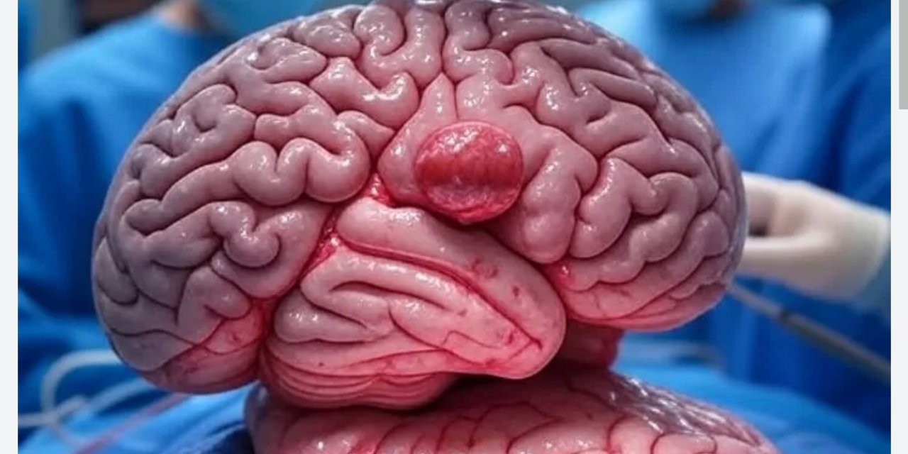 Beyin tümörü ameliyatı sonrası çöken alnı, 3 boyutlu implantla düzeltildi