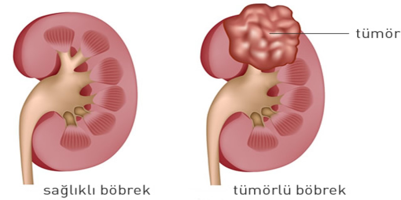Böbrek Kanseri Nedir? Belirtileri, nedenleri ve tedavisi
